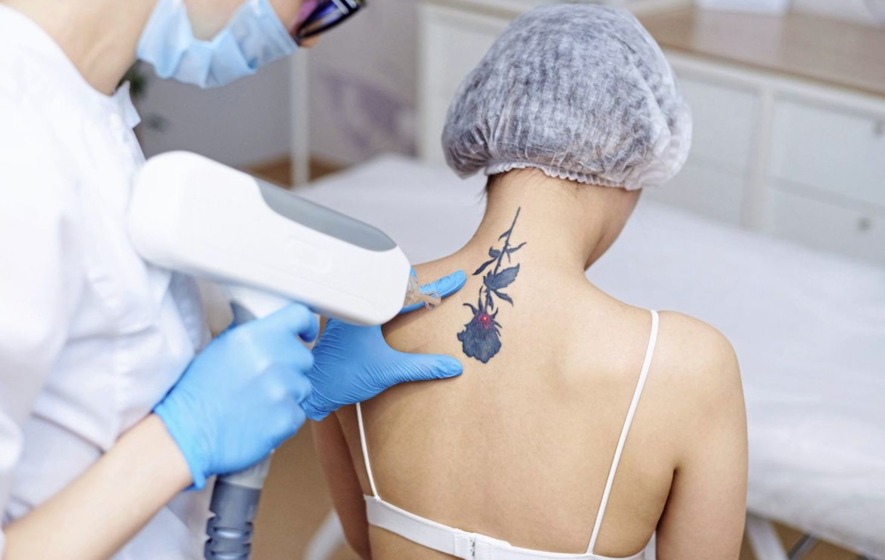 Best Tatto Removal Treatment in Greater Noida
