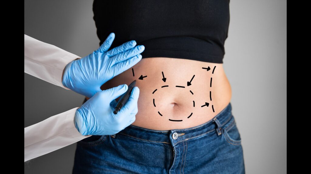 Best Liposuction Surgeon in Noida @ AKS Aesthetic