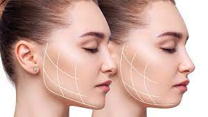 Buccal Fat Removal | Best Plastic Surgeon Greater Noida