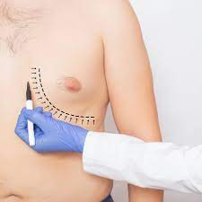 Best Gynecomastia Surgeon in Noida | Dr. Ashwani
