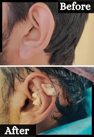 Ear Surgeries​