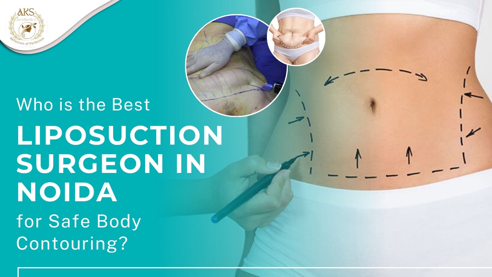 Best Liposuction Surgeon in Noida
